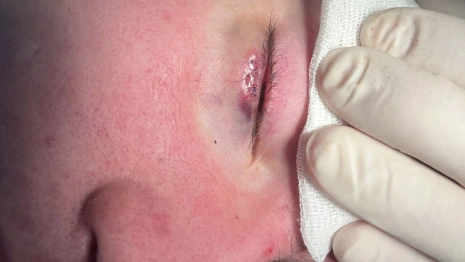 Владимирские врачи спасли ребенка с гигантским ячменем на глазу