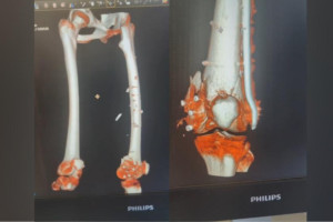 Владимирские врачи поставят на ноги 15-летнюю девочку после ДТП с мотоциклом