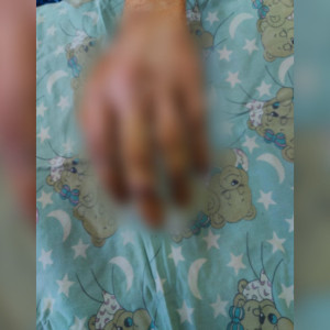 Владимирские врачи спасли поврежденную во время ремонта питбайка руку подростка