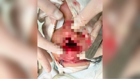 Владимирские врачи спасли ребенка с серьезной травмой лица