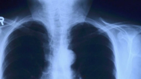 Во владимирском роддоме малышу сломали плечо