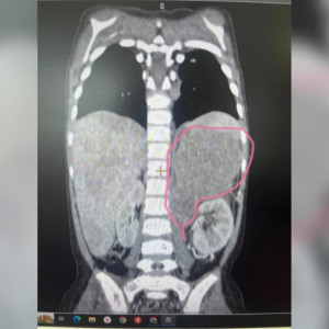 Владимирские врачи обнаружили опасную опухоль у 3-летней девочки