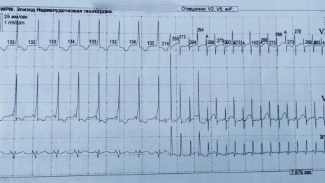 Владимирские врачи стали чаще выявлять феномен WPW у детей