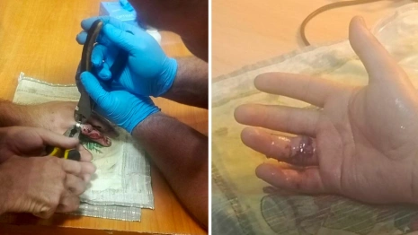 Во Владимире парень едва не оторвал палец при занятиях на турнике