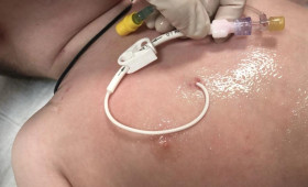 Во Владимире внедрили постановку долгосрочного сосудистого доступа онкобольным детям