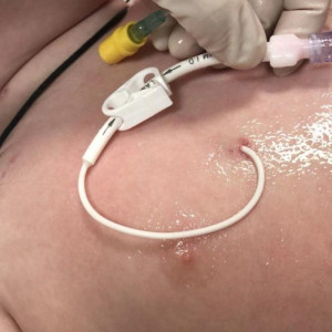 Во Владимире внедрили постановку долгосрочного сосудистого доступа онкобольным детям