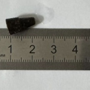 Владимирские врачи достали из бронхов пациента проглоченный 14 лет назад наконечник ручки