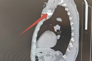 Врачи показали фото осколка в ключице пострадавшего от атаки БПЛА жителя Владимира