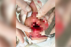 Владимирские врачи спасли ребенка с серьезной травмой лица