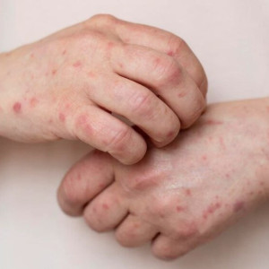 Корь во Владимирской области могли завезти с Бали