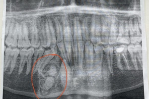 Во Владимирской области у ребенка выросла опухоль с 30 лишними зубами