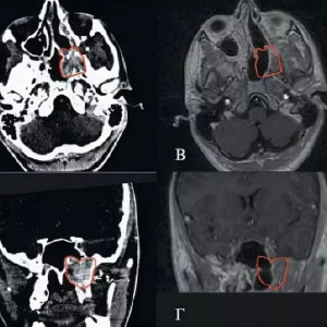 Во Владимире у 15-летнего подростка выявили ангиофиброму черепа