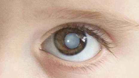 Владимирские врачи спасли ребенка с травмой глаза