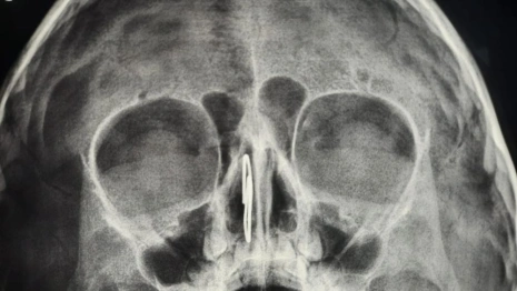 Владимирские врачи извлекли скрепку из носа 4-летнего малыша