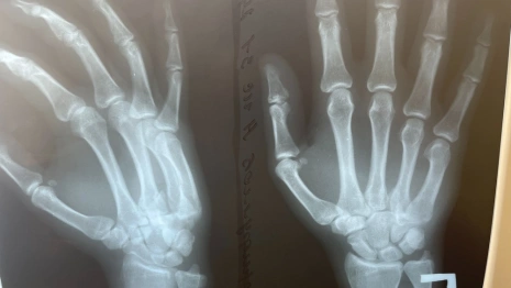 Владимирские врачи спасли пациента с застарелым переломом руки