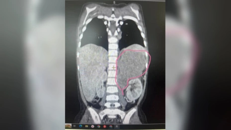 Владимирские врачи обнаружили опасную опухоль у 3-летней девочки