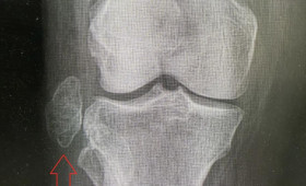 Владимирские врачи удалили опухоль размером с куриное яйцо из коленного сустава пациентки