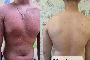 Владимирские врачи спасли подростка с тяжелой формой псориаза