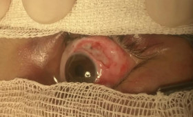 Владимирские врачи спасли 8-летнюю девочку после падения на нее ледяной глыбы