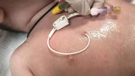 Во Владимире внедрили постановку долгосрочного сосудистого доступа онкобольным детям