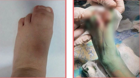 Владимирские врачи спасли 4-летнего малыша с тремя сросшимися пальцами на ноге