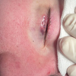 Владимирские врачи спасли ребенка с гигантским ячменем на глазу