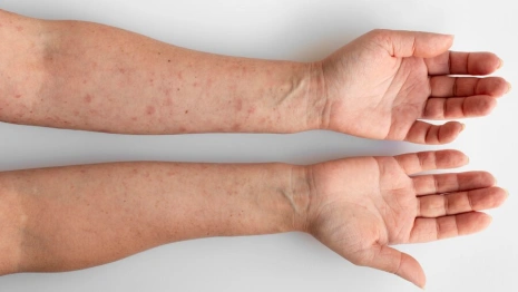 В Гусь-Хрустальном доме ребенка дети заболели корью