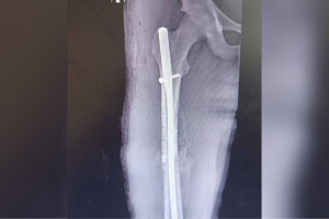 Муромские врачи восстановили бедро пострадавшему в ДТП ребенку