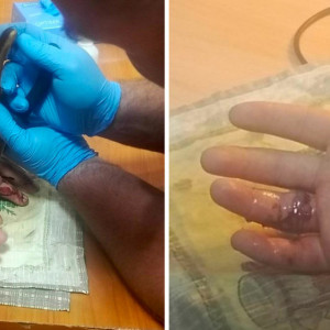 Во Владимире парень едва не оторвал палец при занятиях на турнике