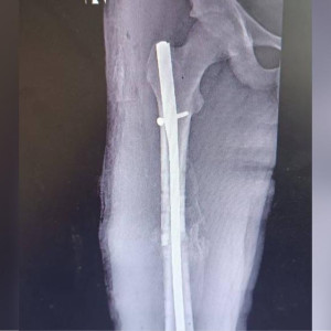 Муромские врачи восстановили бедро пострадавшему в ДТП ребенку