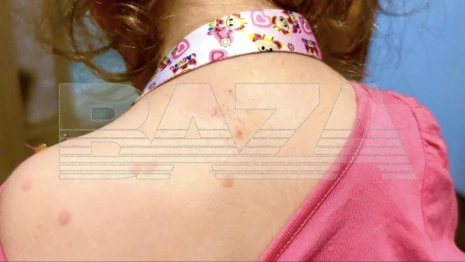 Во Владимире снова зафиксировали случаи заражения вирусом Коксаки