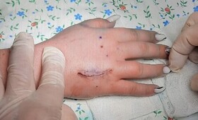 Во Владимире прооперировали 17-летнюю девушку с коротким безымянным пальцем