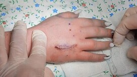 Во Владимире прооперировали 17-летнюю девушку с коротким безымянным пальцем