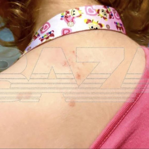 Во Владимире снова зафиксировали случаи заражения вирусом Коксаки