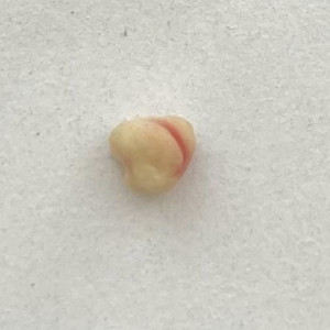 Владимирские врачи удалили камень из протока слюной железы ребенка