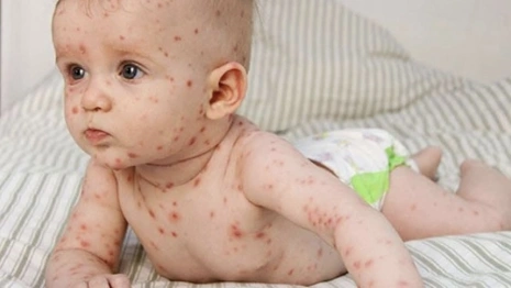 Владимирские врачи спасли 11-месячного ребенка с ветряной оспой