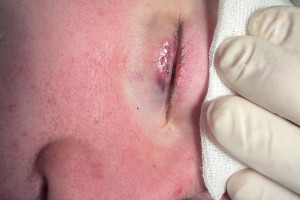 Владимирские врачи спасли ребенка с гигантским ячменем на глазу