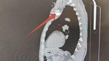 Врачи показали фото осколка в ключице пострадавшего от атаки БПЛА жителя Владимира