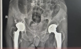В Коврове медики освоили передовые методы лечения переломов тазобедренного сустава