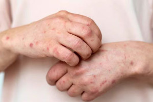 Заболеваемость корью во Владимирской области снизилась в 9 раз