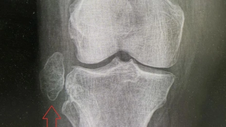 Владимирские врачи удалили опухоль размером с куриное яйцо из коленного сустава пациентки