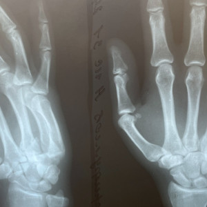 Владимирские врачи спасли пациента с застарелым переломом руки