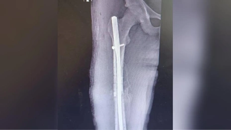 Муромские врачи восстановили бедро пострадавшему в ДТП ребенку