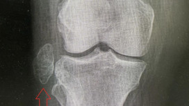 Владимирские врачи удалили опухоль размером с куриное яйцо из коленного сустава пациентки
