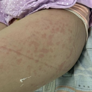 Из Владимира на вертолете эвакуировали 10-летнюю девочку с юношеским артритом