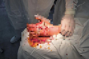 Владимирские врачи провели уникальную операцию пострадавшему от взрыва петарды ребенку