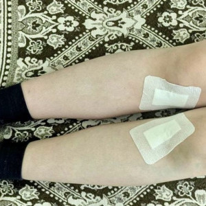 Владимирские врачи исправили х-образную деформацию ног подростку