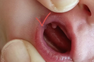 Владимирские врачи удалили новорожденному малышу опухоль во рту