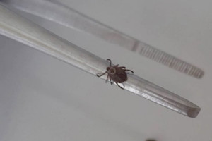 Во Владимирской области с людей сняли 2 зараженных болезнью Лайма клещей