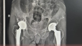 В Коврове медики освоили передовые методы лечения переломов тазобедренного сустава